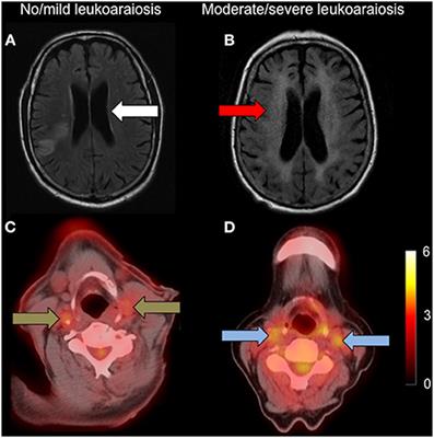 Carotid Atheroinflammation Is Associated With Cerebral Small Vessel Disease Severity